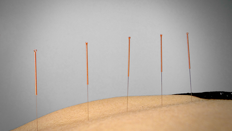 Acupuncture à Valence