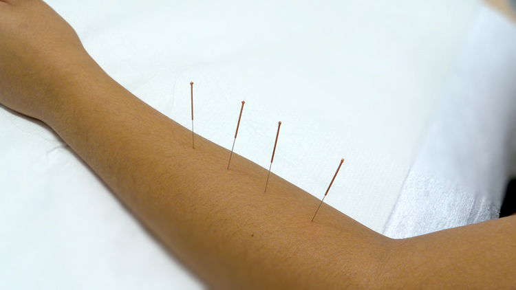 Acupuncture